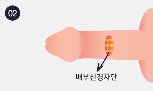 배부신경차단술 이미지