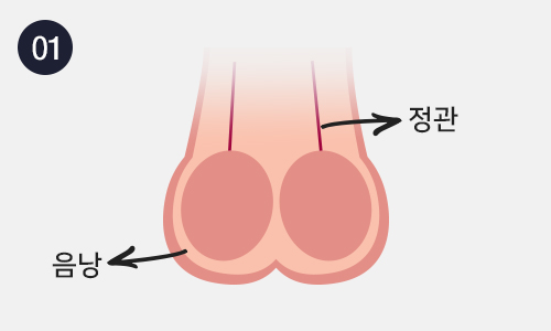 무도정관수술 이미지