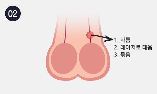 무도정관수술 이미지