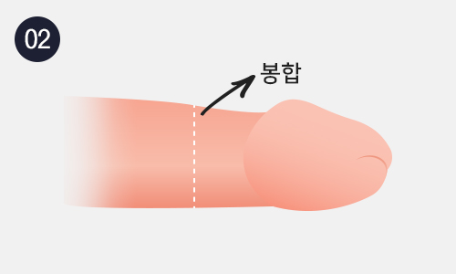 레이져포경수술 이미지