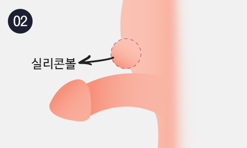 치골융기수술 이미지