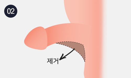 음낭갈퀴제거수술 이미지