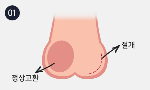 인조고환삽입수술 이미지