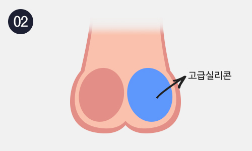 인조고환삽입수술 이미지