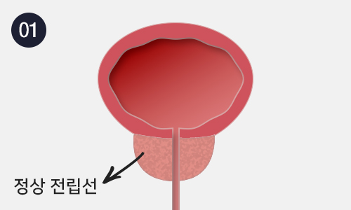 전립선비대증 이미지