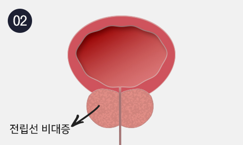 전립선비대증 이미지