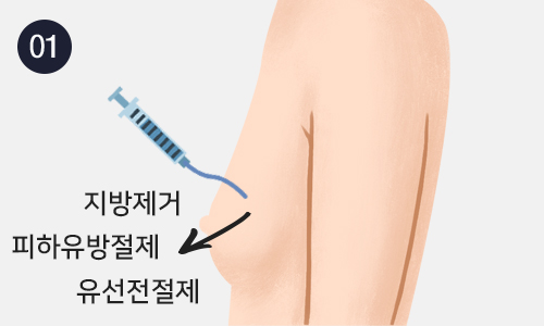 여유증 이미지