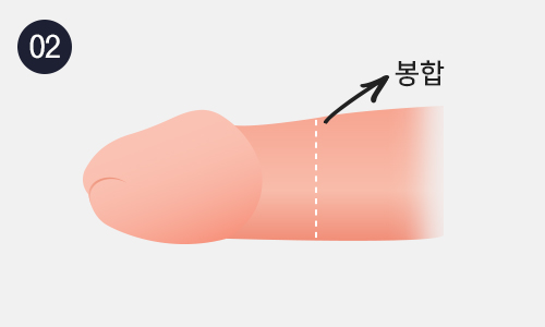 바세린제거수술 이미지