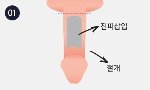 대체진피 음경확대 이미지