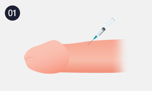필러 음경확대 이미지