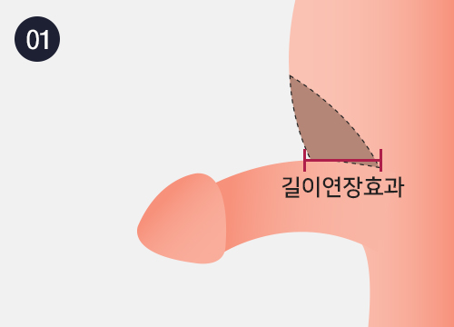 치골지방흡입술 이미지