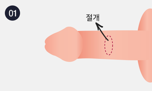 배부신경차단술 이미지